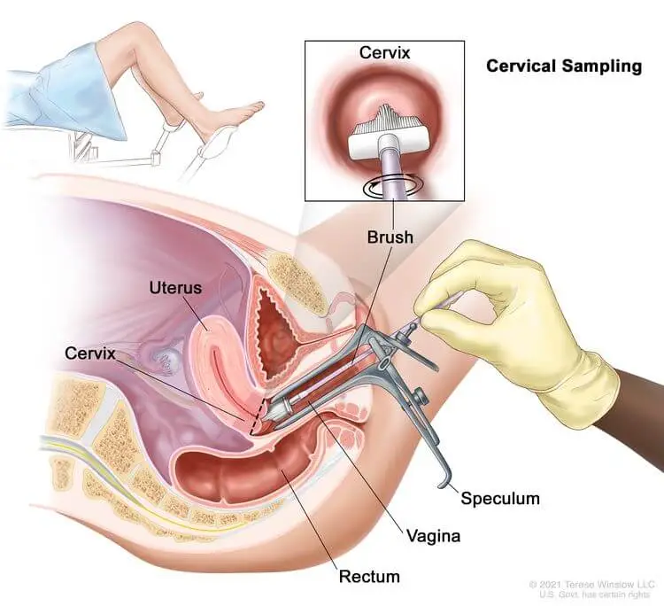 Cervical Cancer Screening