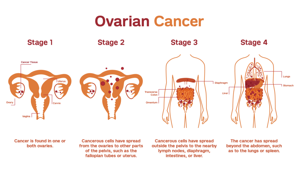 Ovarian Cancer